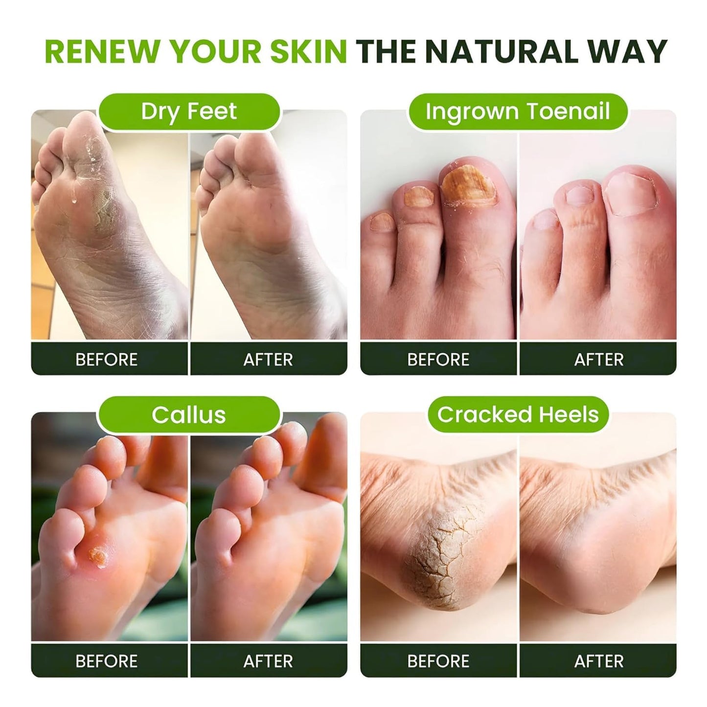 Tea Tree Oil Foot Soak with Epsom Salts- for Foot Pain, Soreness, Athletes Foot, Odors, Toe Nail Fungus, Fungal, Calluses Made in USA - 4 Pack
