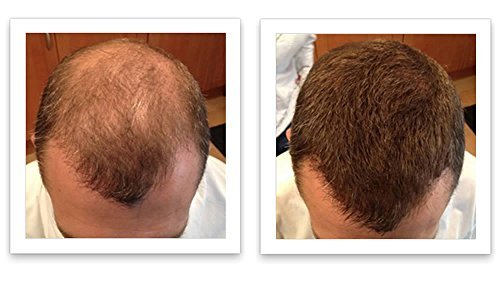Caboki Hair Building Fiber. (30G, 90-Day Supply). Auburn