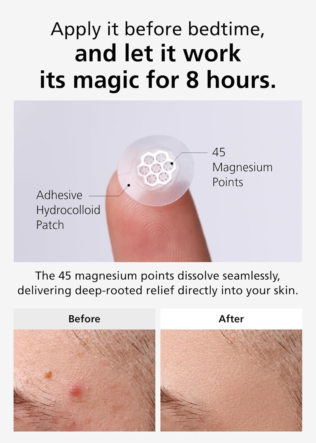 EasyDerm Quick Calming Magnesium Patches – 40 Patches (4 Pack), Hydrocolloid Acne Spot Treatment with Tea Tree & Cica, Bulk Value Pack for Acne-Prone Skin, Ideal for Home Skincare