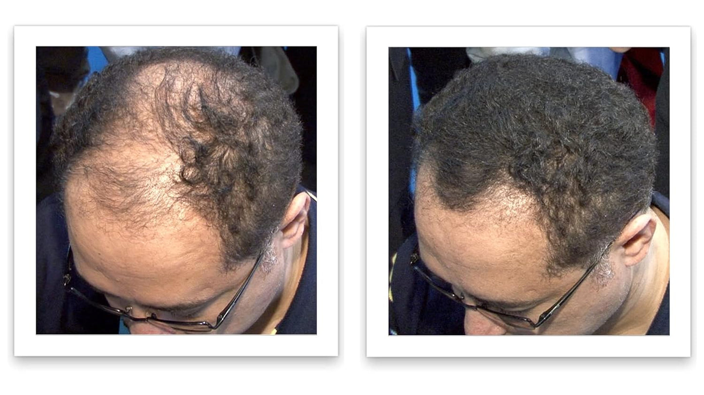 Caboki Hair Loss Concealer, All-Natural Hair Building Fiber. Make Thin Hair Look 10X Fuller Instantly. Eliminate the Appearance of Bald Spot and Thinning Hair (30G, 90-Day Supply). Black