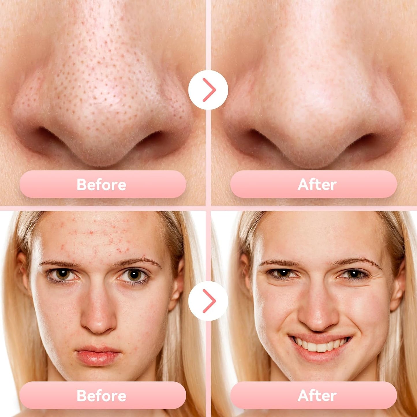 Blackhead Remover Pore Vacuum Upgraded Facial Pore Cleaner Electric Comedone Whitehead Extractor Tool-5 Suction Power,5 Probes,USB Rechargeable