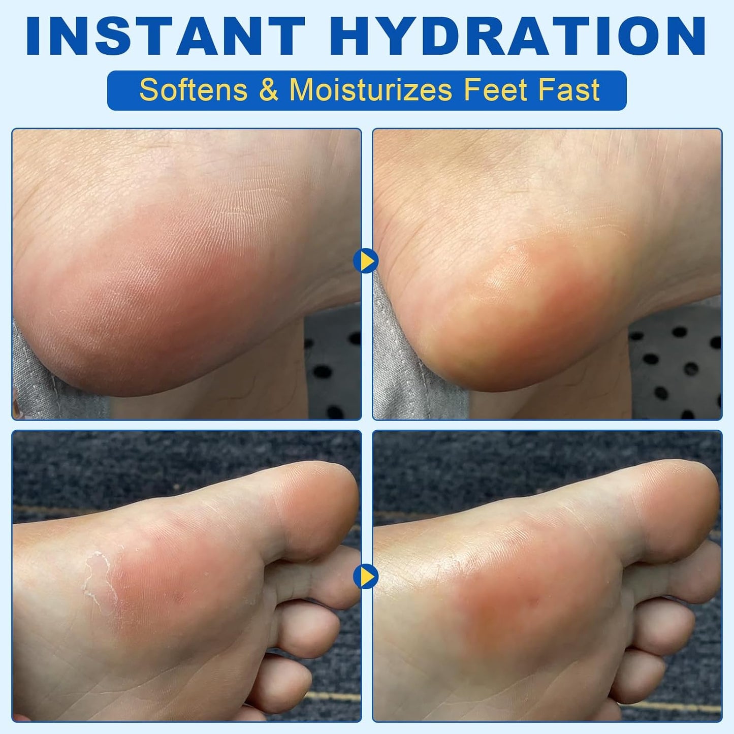 Foot Urea Cream, 60% Urea Cream for Feet Maximum Strength Repair Cracked Skin, Foot Moisturizer Nourish Cracking Rough Dry Heels, Feet Callus Remover Gel, 1.41Fl Oz