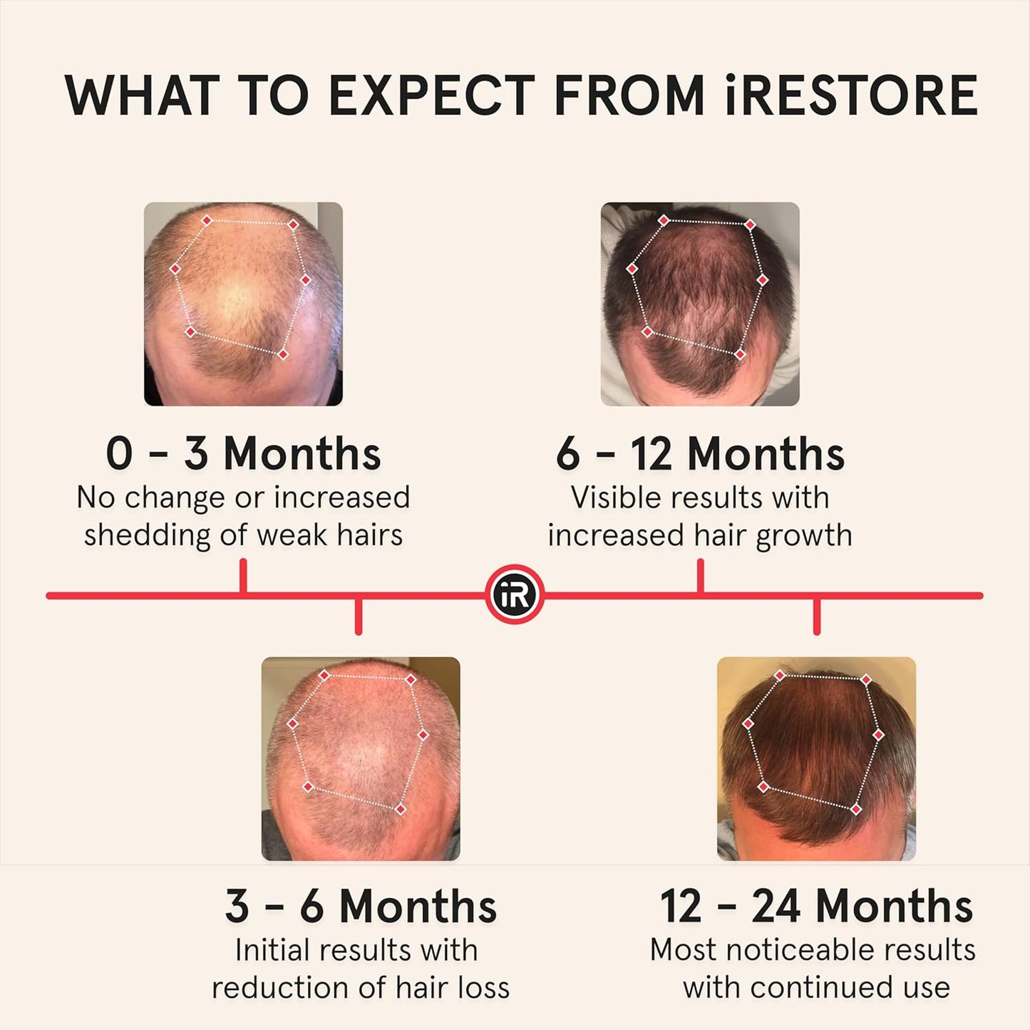 iRestore Professional Laser Red Light Therapy for Hair Growth System - FDA Cleared Hair Loss, Hair Thinning & Alopecia Treatment for Men & Women - 282 Lasers & LEDs