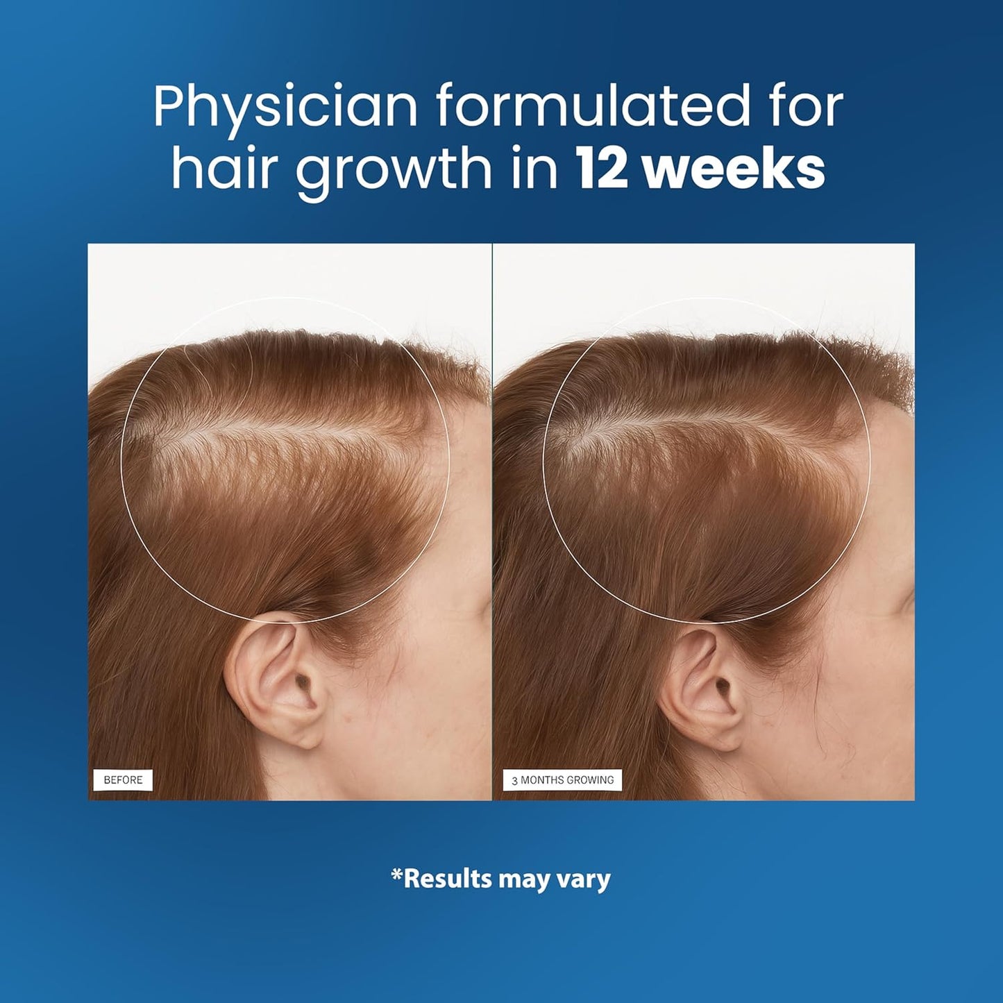 Be Bodywise Rosemary Hair Growth Serum Roll On 25 ml – 3% Rosemary, 3% Redensyl & 2% Anagain | DHT-Blocking Scalp Serum Boosts Oxygen Flow, Reduces Hair Fall | Paraben/Sulfate-Free | Women & Men