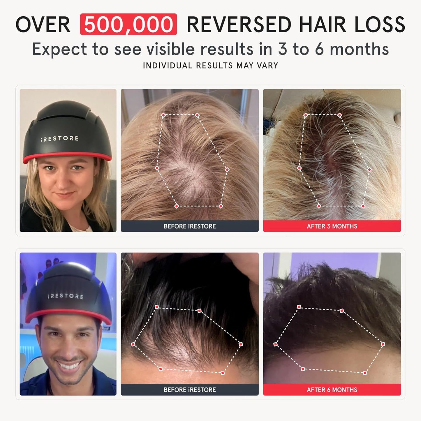 iRestore Elite + Rechargeable Battery Pack - Laser Red Light Therapy for Hair Growth - FDA Cleared Hair Loss, Hair Thinning Treatment for Men & Women - Hair Regrowth Laser Cap - 500 Lasers & LEDs